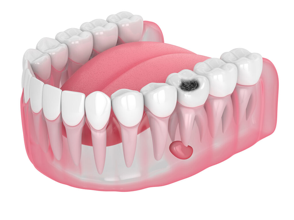Granulom dentar. Ocurențe și tratament - IVORY Dentfix